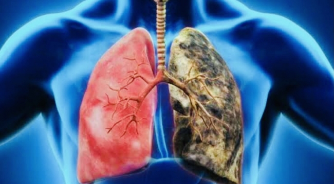 Obstrüktif akciğer hastalıkları ve Obstrüktif akciğer hastalıklarının tedavisi