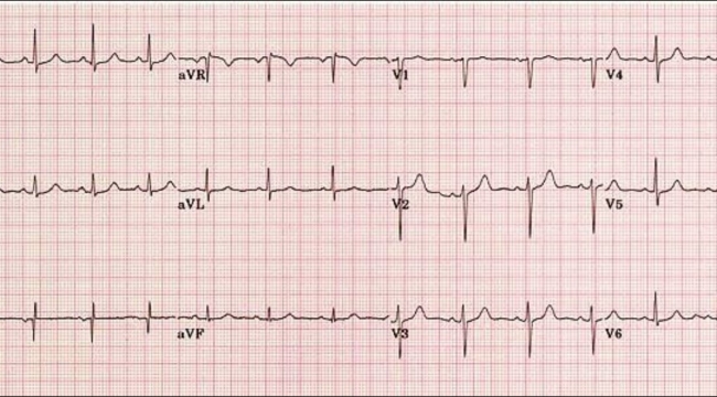 EKG nedir, EKG kağıdı nasıl okunur?