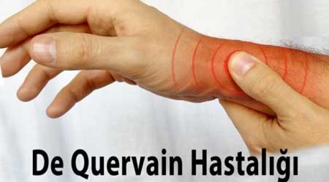 De Quervain Tenosiniviti nedir, bulgular ve yapılan tanı testi