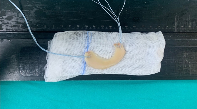 Samsun'da bir hastaya menisküs nakli yapıldı