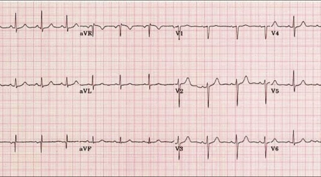 EKG nedir, EKG kağıdı nasıl okunur?